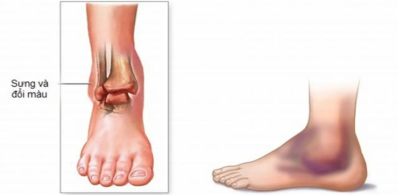 Các loại chấn thương phổ biến trong thể thao và tại sao Bình xịt lạnh giảm đau Ligpro là lựa chọn ưu tiên hàng đầu?